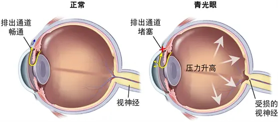 青光眼发病机制示意图