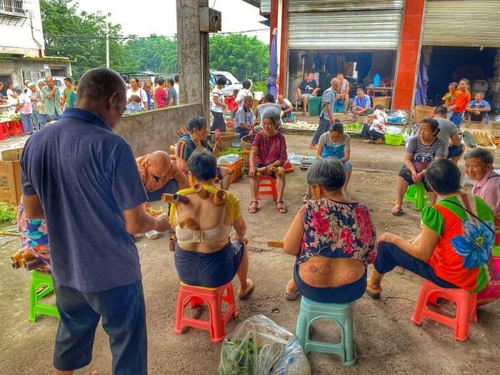 镇上赶集，拔火罐 摄影/易小荷 刘溯