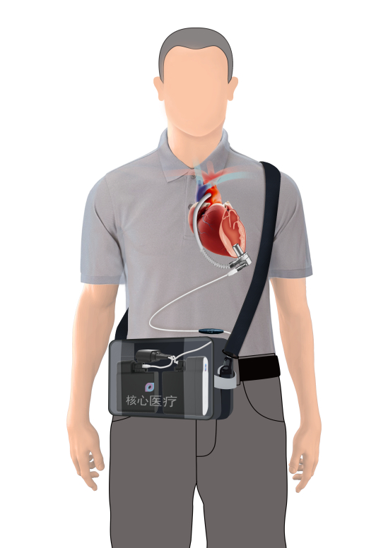 人工心脏体内、体外设备结构示意图，图源：核心医疗