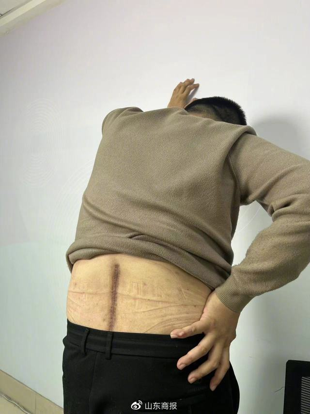 李亮后腰这道手术伤疤，时不时隐隐作痛记者 张舒 摄