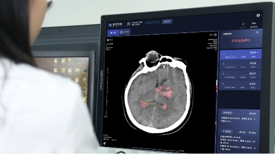 　　医院应用数坤颅内出血CT图像辅助分诊软件对急性脑出血进行诊断