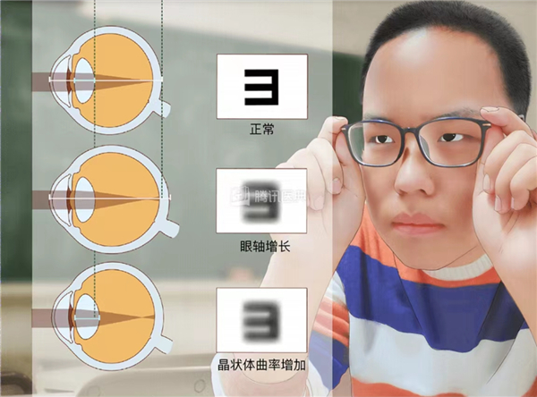 近视。图片来源：腾讯医典
