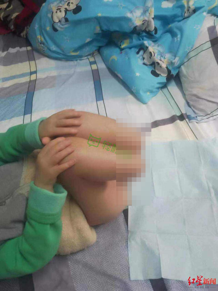 ↑男童永远失去了双小腿