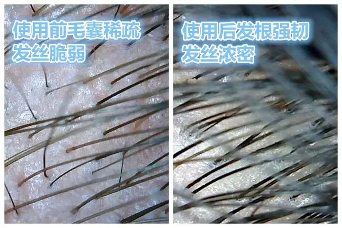 经过改善修复后的毛囊，发根也变得支棱起来，大大减少了由毛囊萎缩造成的脱发。