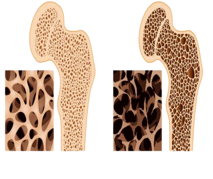 　　正常骨质结构 骨质疏松患者骨质结构