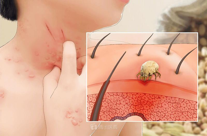 图片来源：腾讯医典