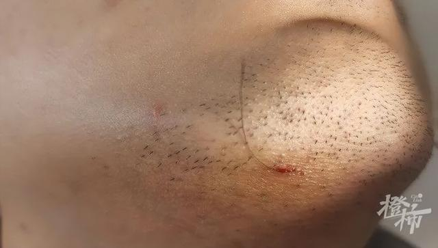毛发被挑出后 医院供图