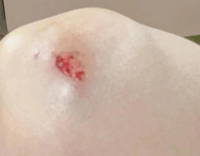 ↑李女士摔倒后手臂被擦破。受访者供图