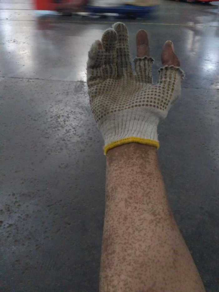 做德邦理货员期间，灰尘混合着汗液，在胡安焉手臂上留下的污渍&nbsp; &nbsp;受访者供图