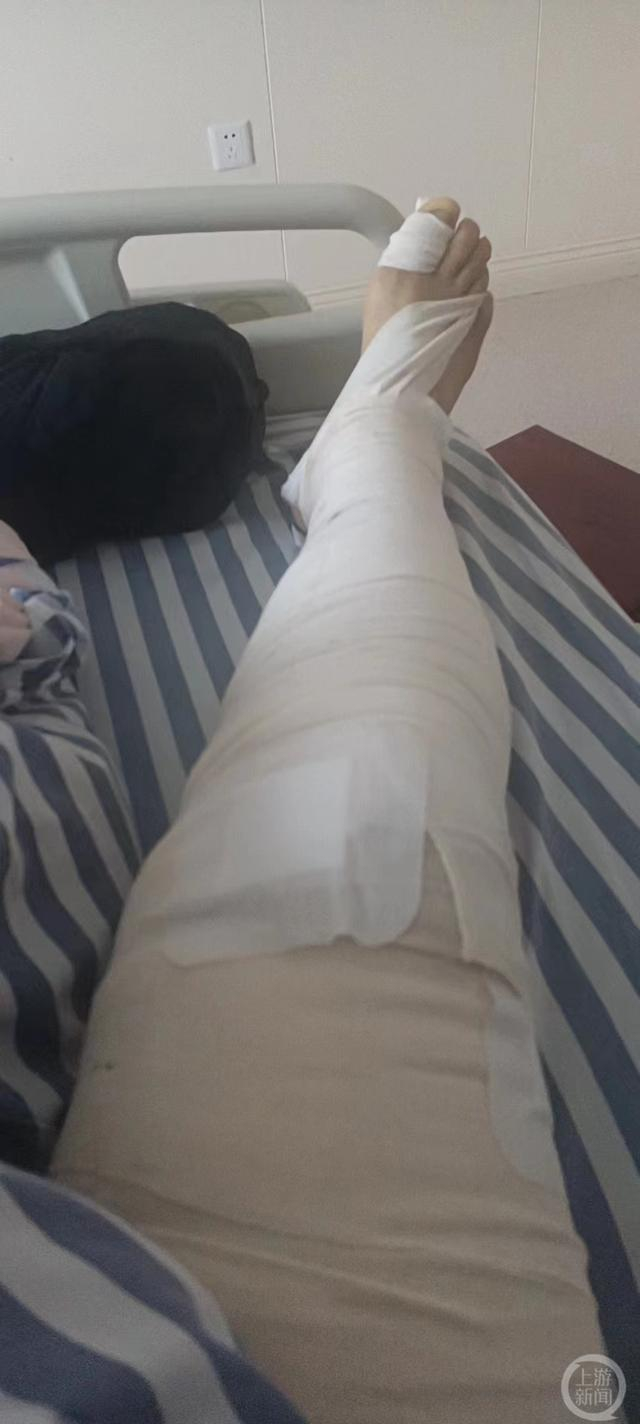 ▲术后，胡荣梁腿部肿大。受访者供图