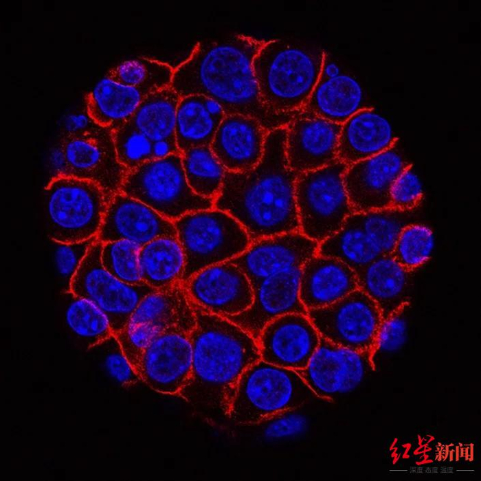 ↑胰腺癌细胞显微镜图像