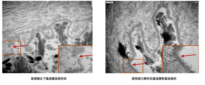 △高倍透射电镜下基底膜断裂修护对比