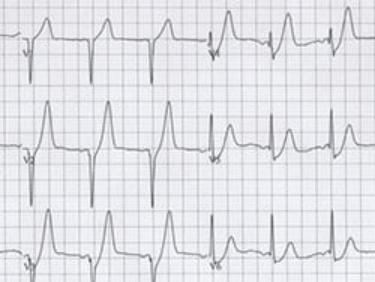 动态心电图：记录24小时