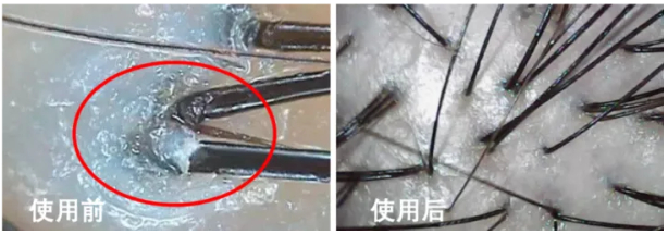 △显微镜下的去屑效果