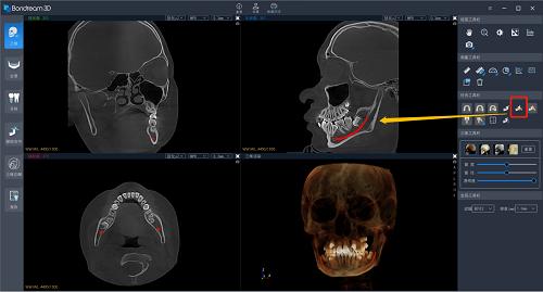 ▲Bondream 3D AI描绘双侧神经管界面