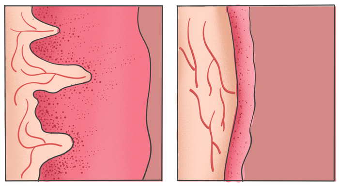 左图为正常阴道黏膜、右图为萎缩阴道黏膜