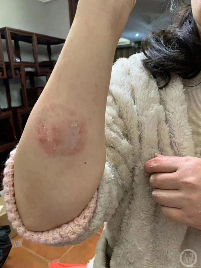 ▲2022年12月11日，刘女士称，她再次遭到丈夫家暴，手臂、腹部等出现多处淤青。图片来源/受访者供图