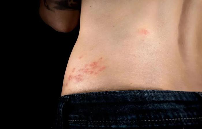 带状疱疹所引起的水疱常见于腰部，因此带状疱疹也俗称为“缠腰龙”“蛇缠腰”。图/视觉中国