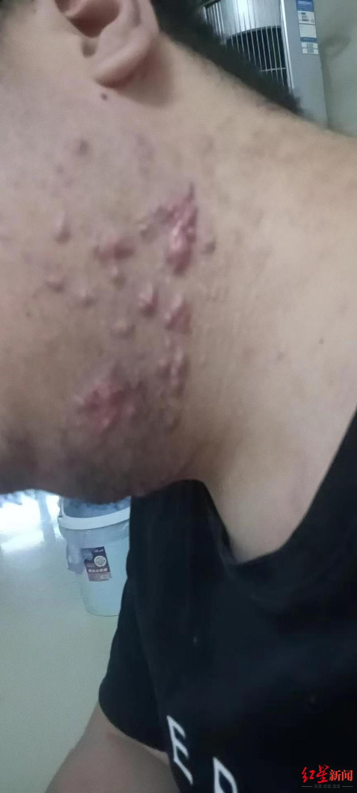 ▲郝少杰下颌处因毛囊炎留下的瘢痕