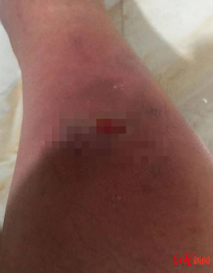 ▲阿乐被殴打后的伤痕。 受访者供图