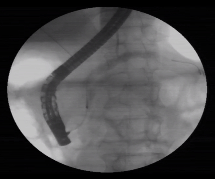 图6：胆管导丝已被占据（左上），