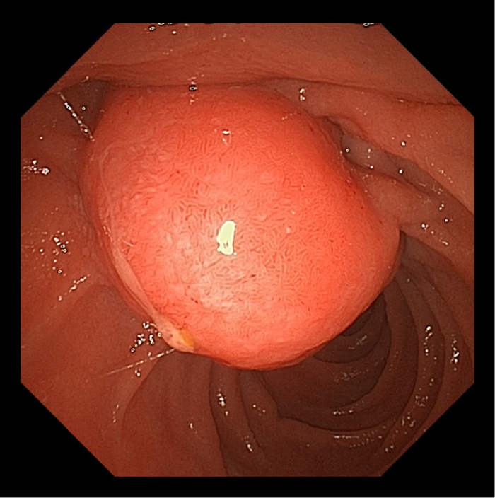 图1：十二指肠镜下观察