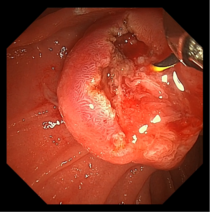 图3：循原窦道置入导丝