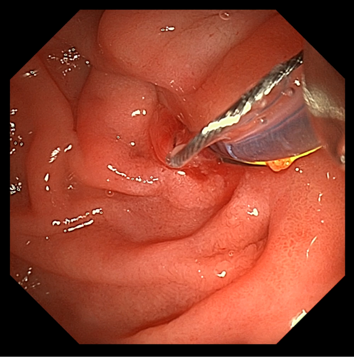 图2：横向插入扩张探条于胰管内