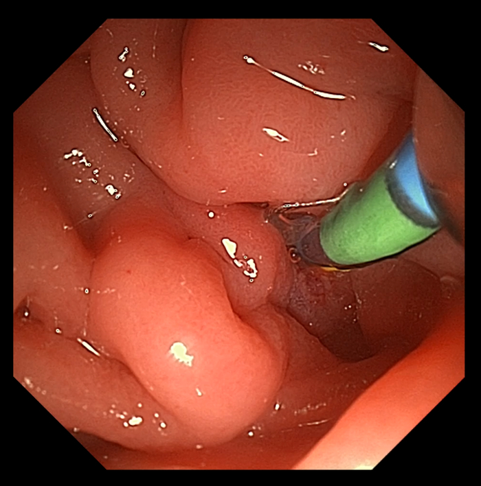 图1：置入导管，插入胆管