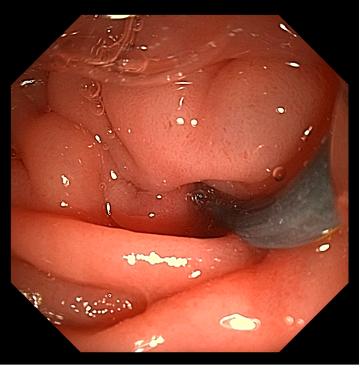 图3：于胰管内扩张探条