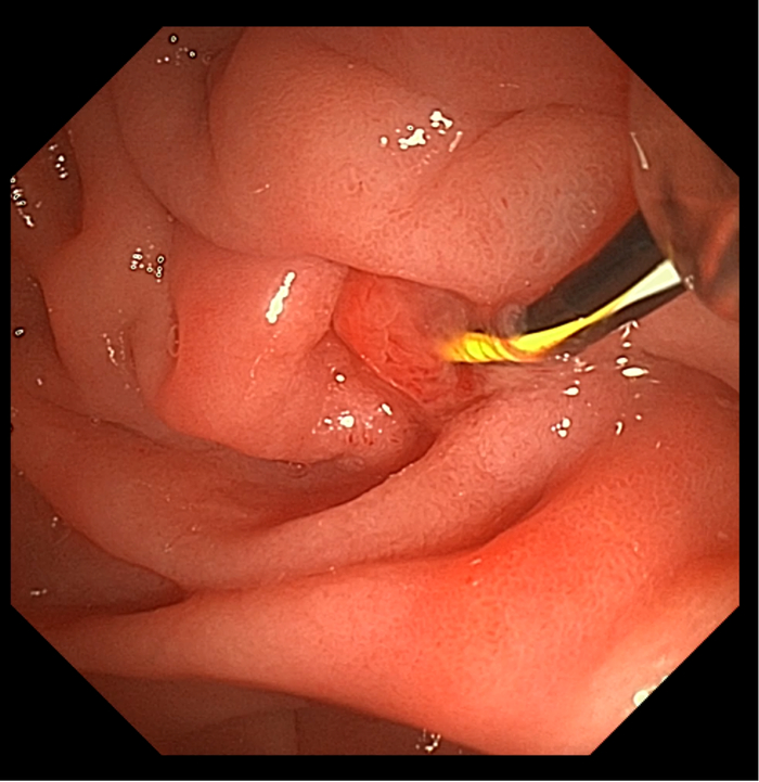 图4：取石网篮或球囊导管将“结石”脱出