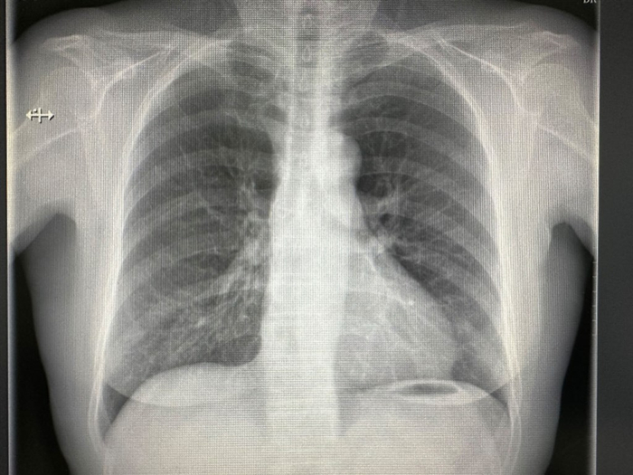 图1王阿姨的胸片  