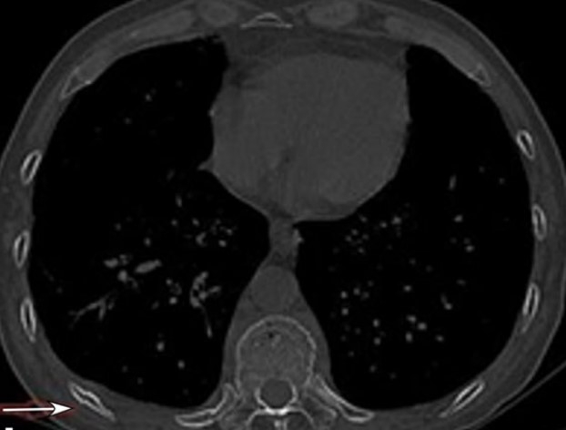 图4白色箭头所指处的弯曲骨折  