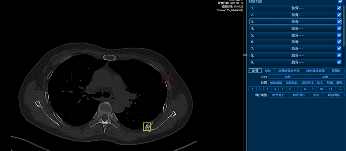 图5肋骨骨折智能辅助诊断系统—图中的黄色框即AI提示骨折处  