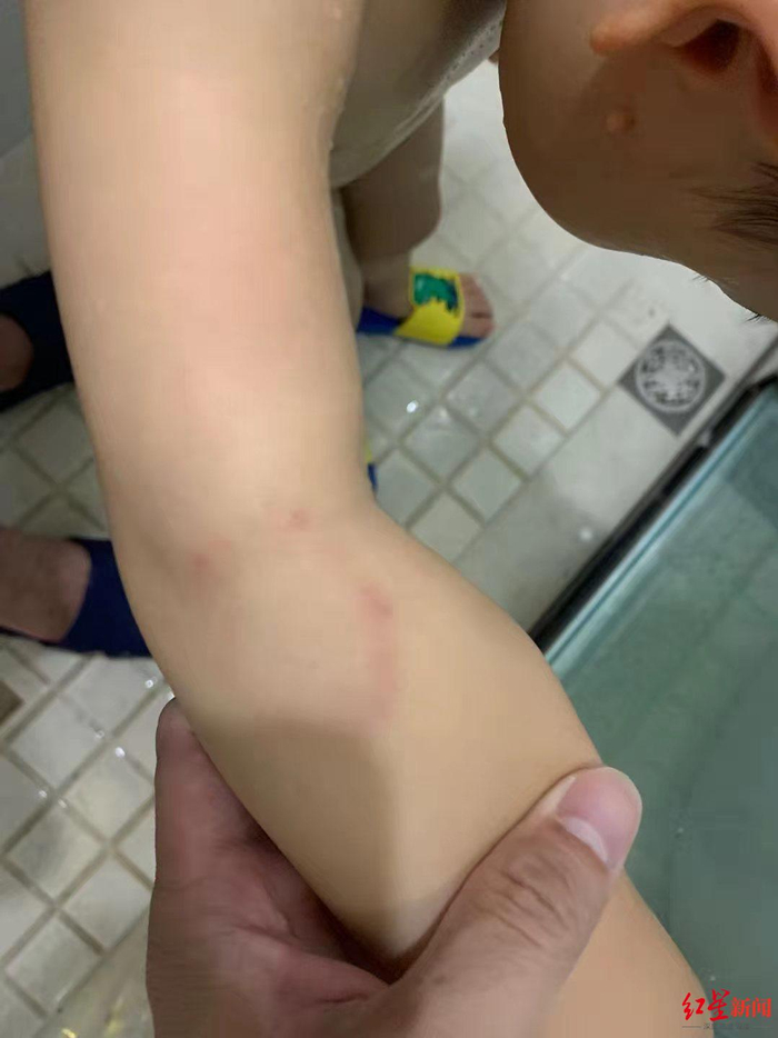 ↑孩子受伤的照片