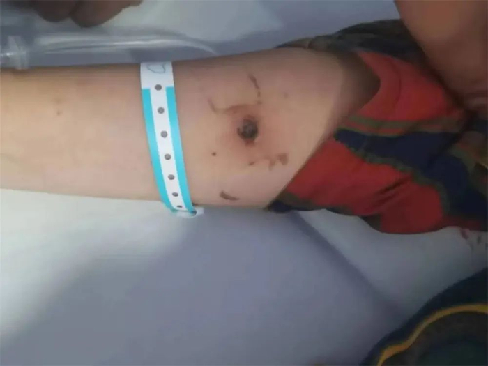 患者右手肘部有焦痂。医院供图