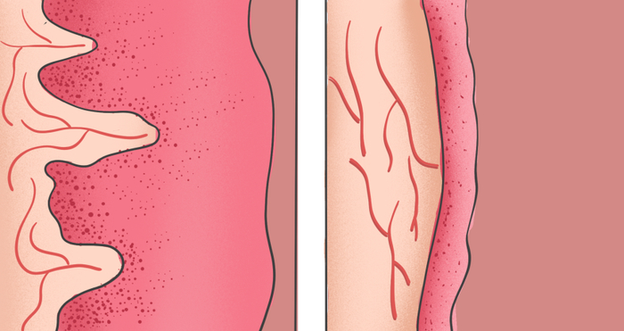 左图为正常阴道黏膜、右图为萎缩阴道黏膜