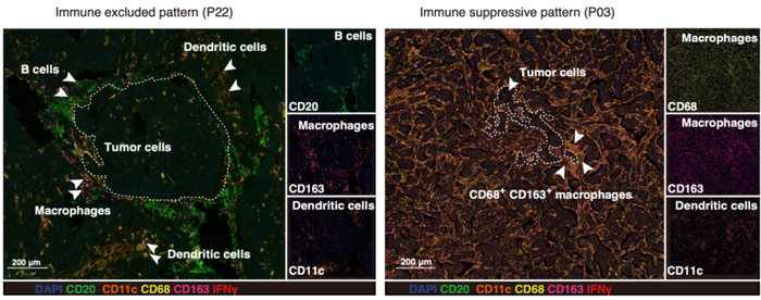 图4. “免疫排斥型”与“免疫抑制型”微环境空间特征