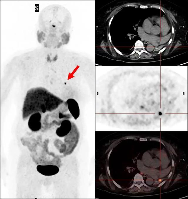 范阿姨左肺中分泌ACTH激素的支气管类癌