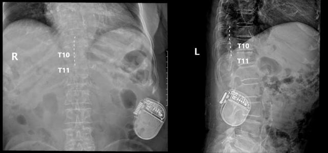 ▲术后复查可见电极放置在T9-T11节段脊髓后方/图源 重医附二院疼痛科