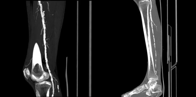 ▲球囊扩张术前下肢动脉CTA/图源 重医附二院疼痛科