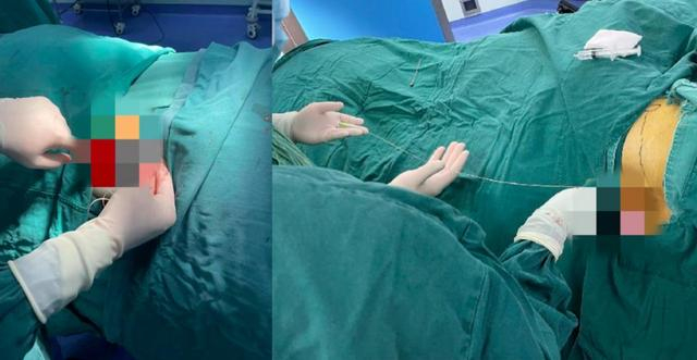 ▲脊髓电刺激术进行中/图源 重医附二院疼痛科