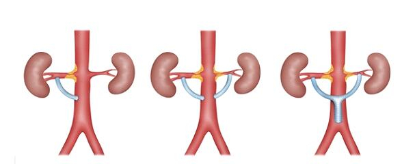 图3:肾动脉狭窄的开放手术——旁路手术