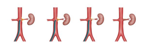 图4:肾动脉狭窄球囊扩张支架植入术示意图