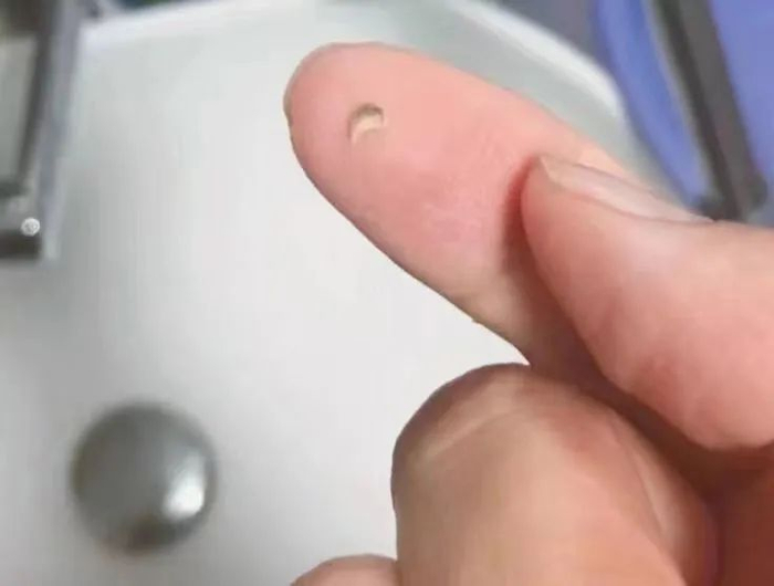 ▲刷牙时掉落的牙结石