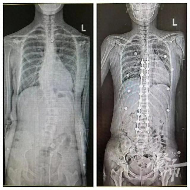 可可手术前后的对比图 医院供图