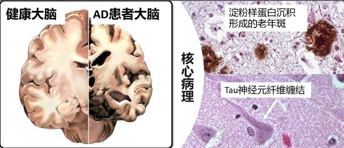 ▲AD患者的大脑图像