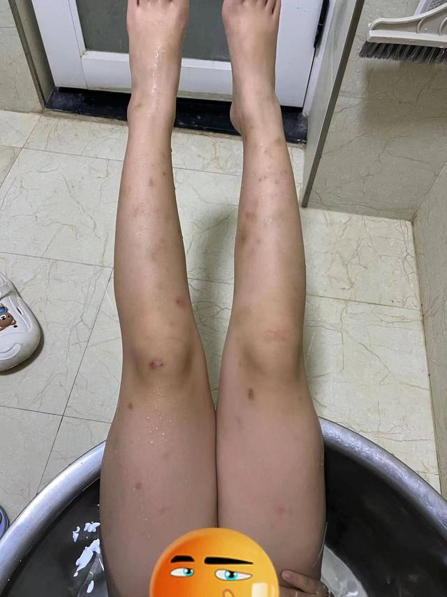 学生出现的过敏症状。受访者供图