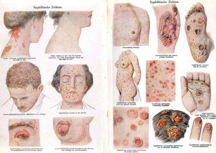 第二期梅毒，图片来源：wikipedia