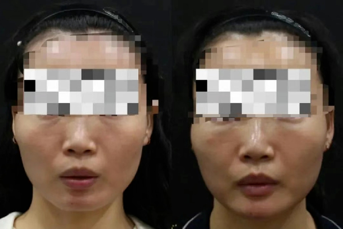 ▲彭女士微整形前（左）后（右）对比